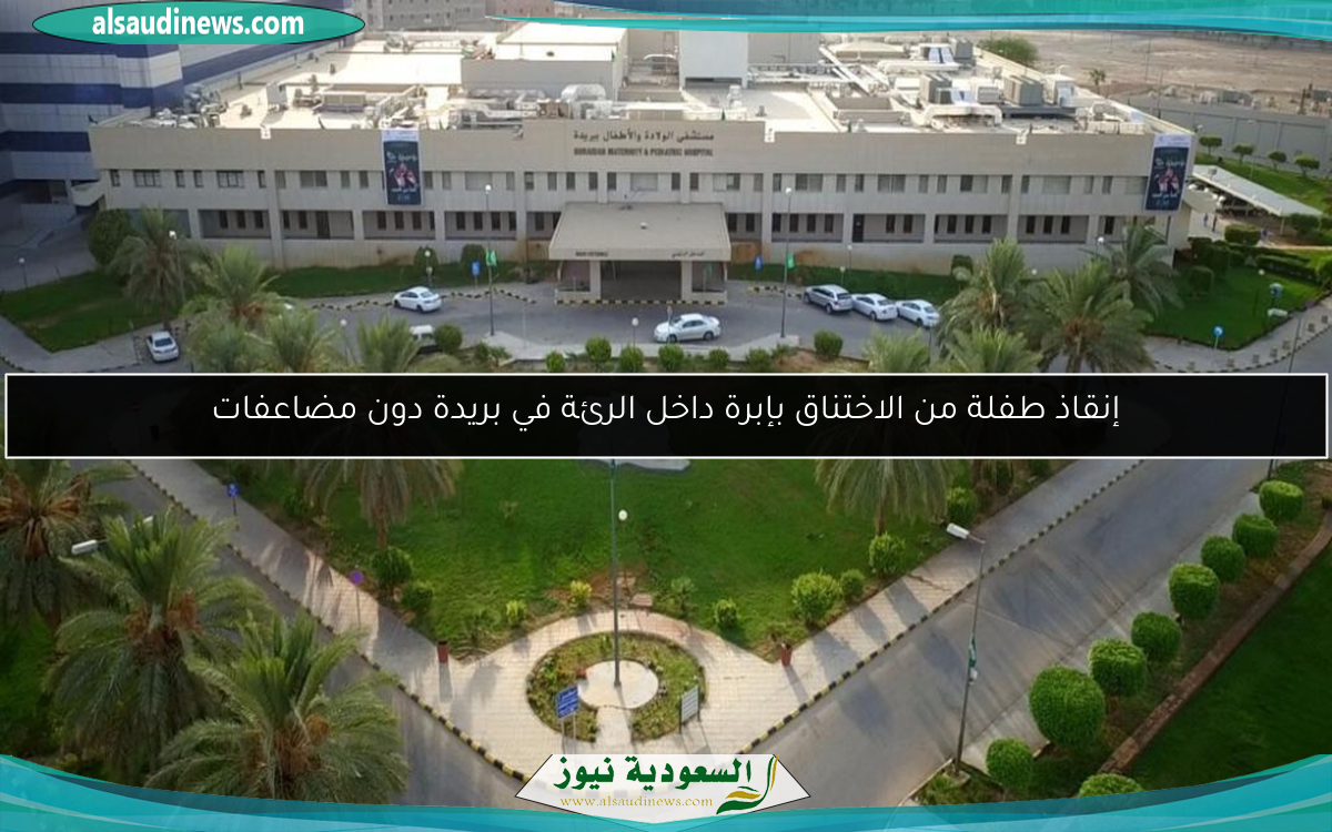 إنقاذ طفلة من الاختناق بإبرة داخل الرئة في بريدة دون مضاعفات