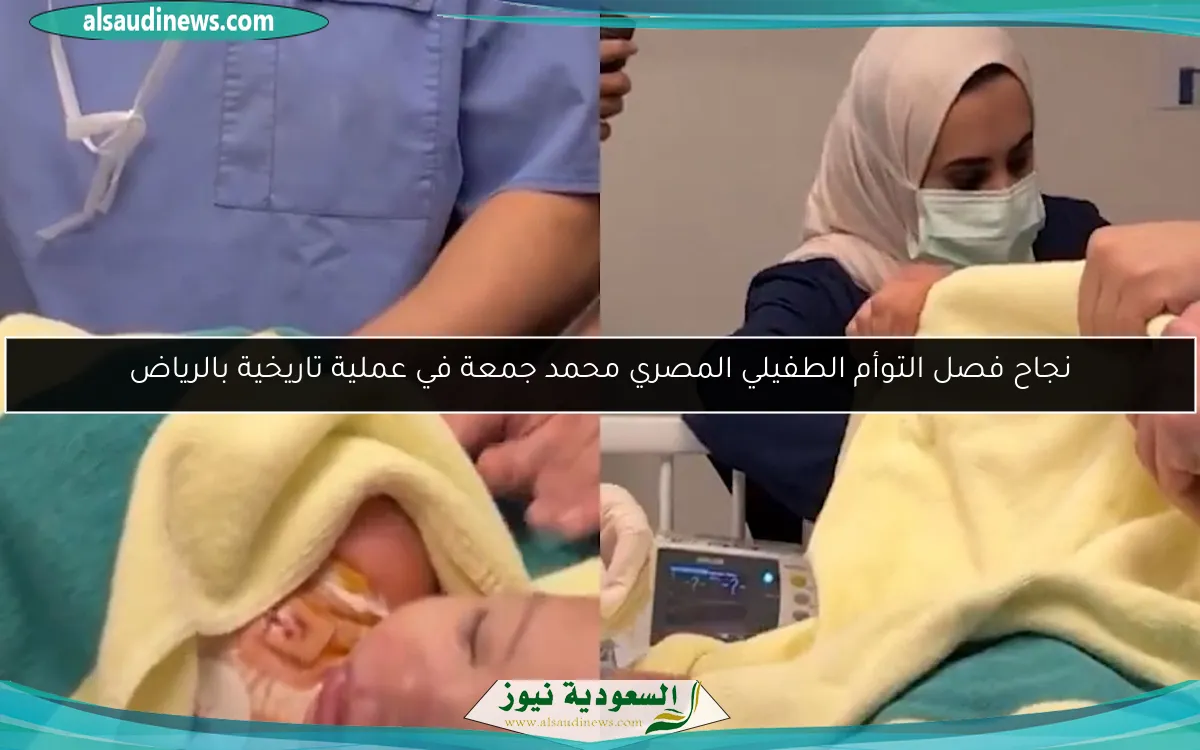 نجاح فصل التوأم الطفيلي المصري محمد جمعة في عملية تاريخية بالرياض