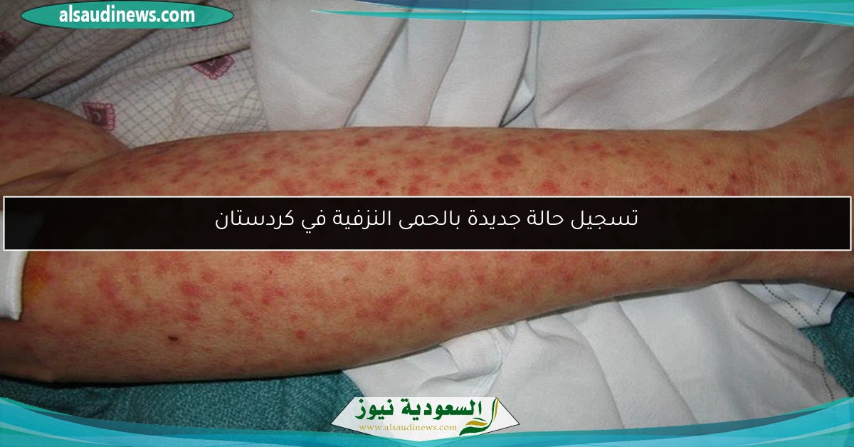 تسجيل حالة جديدة بالحمى النزفية في كردستان