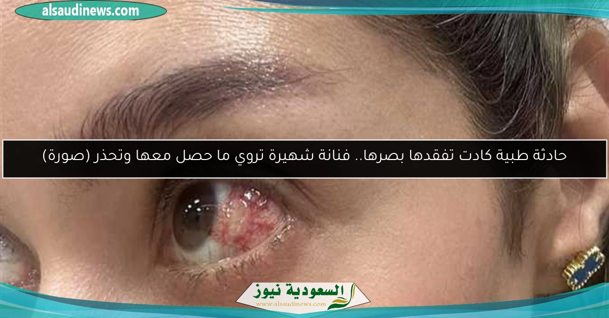 حادثة طبية كادت تفقدها بصرها.. فنانة شهيرة تروي ما حصل معها وتحذر (صورة)