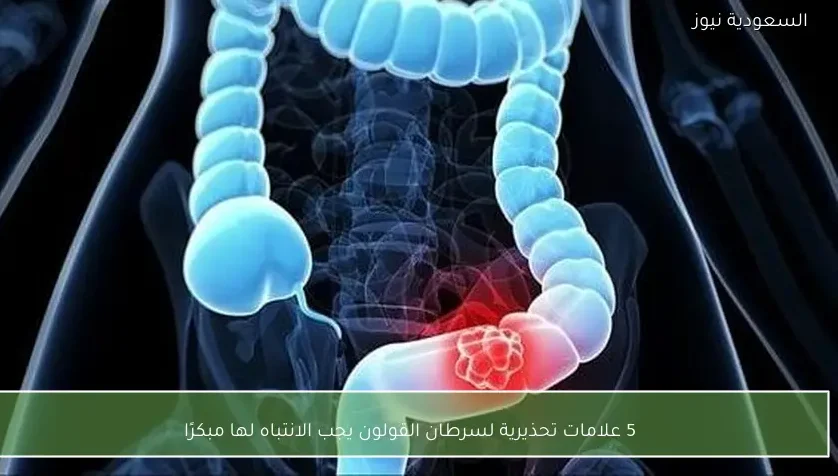 5 علامات تحذيرية لسرطان القولون يجب الانتباه لها مبكرًا