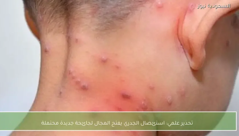 تحذير علمي: استئصال الجدري يفتح المجال لجائحة جديدة محتملة