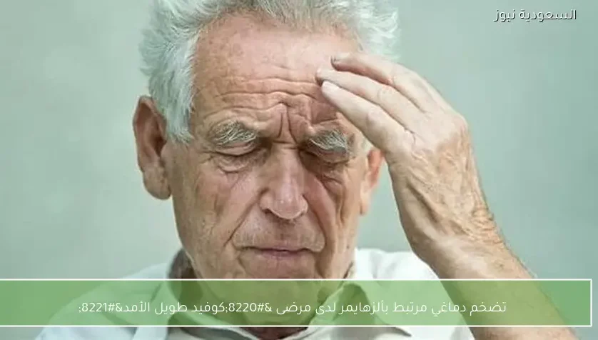 تضخم دماغي مرتبط بألزهايمر لدى مرضى “كوفيد طويل الأمد”
