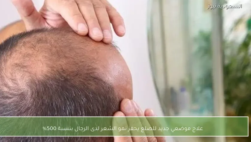 علاج موضعي جديد للصلع يحفز نمو الشعر لدى الرجال بنسبة 500%