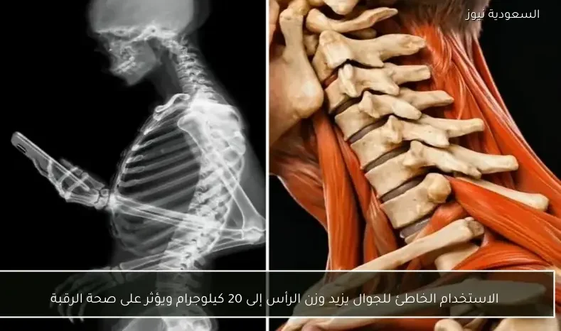 الاستخدام الخاطئ للجوال يزيد وزن الرأس إلى 20 كيلوجرام ويؤثر على صحة الرقبة