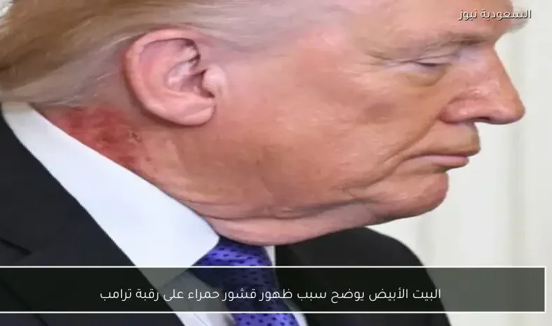 البيت الأبيض يوضح سبب ظهور قشور حمراء على رقبة ترامب